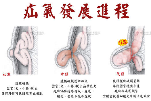 疝氣發展進程